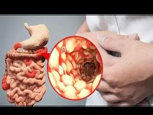 علائم ابتلا به ویروس‌ جدید گوارشی / این داروی ممنوعه را مصرف نکنید!