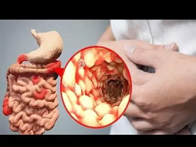 علائم ابتلا به ویروس‌ جدید گوارشی / این داروی ممنوعه را مصرف نکنید!