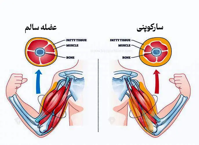 سارکوپنی چیست؟ +راهکارهای پیشگیری