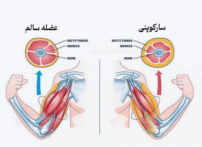 سارکوپنی چیست؟ +راهکارهای پیشگیری