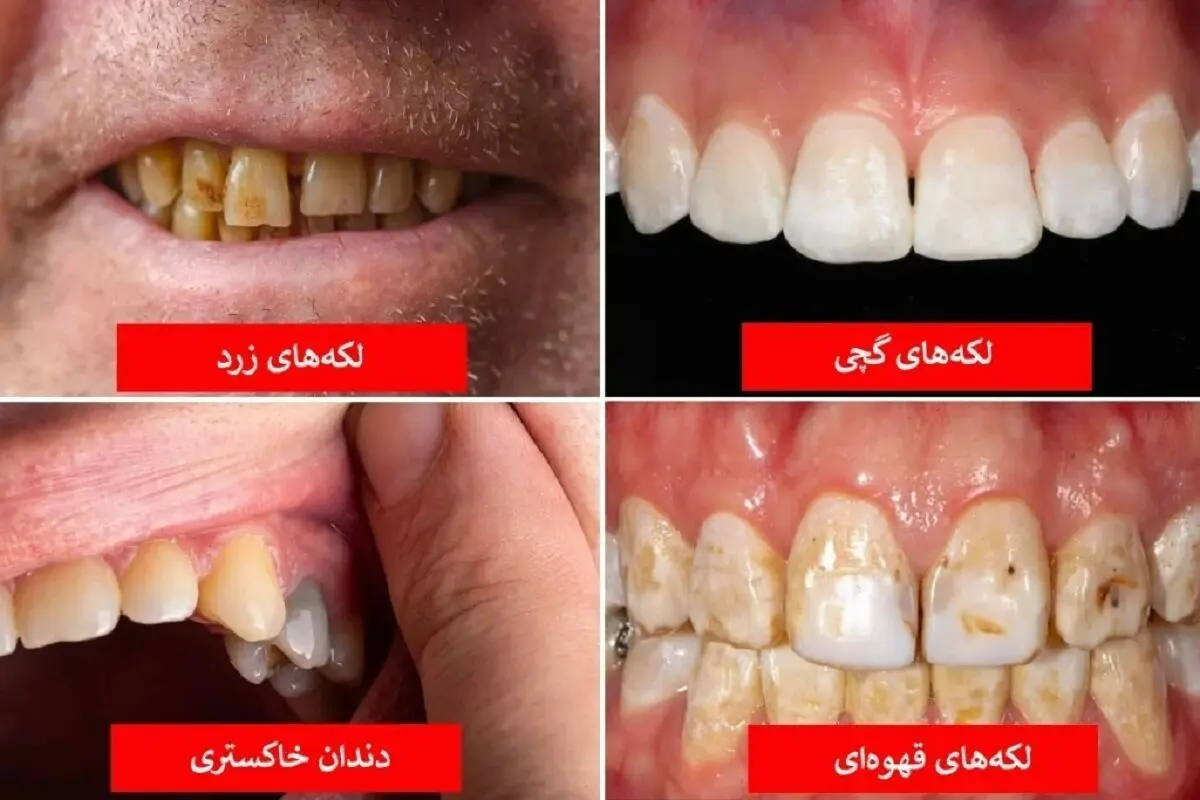رنگ دندان‌ها را جدی بگیرید / این رنگ علائم مرگ است!

