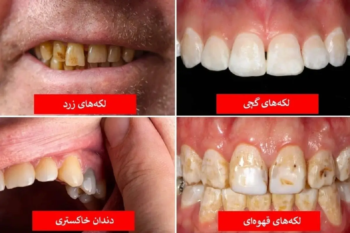 رنگ دندانها را جدی بگیرید / این رنگ علائم مرگ است!