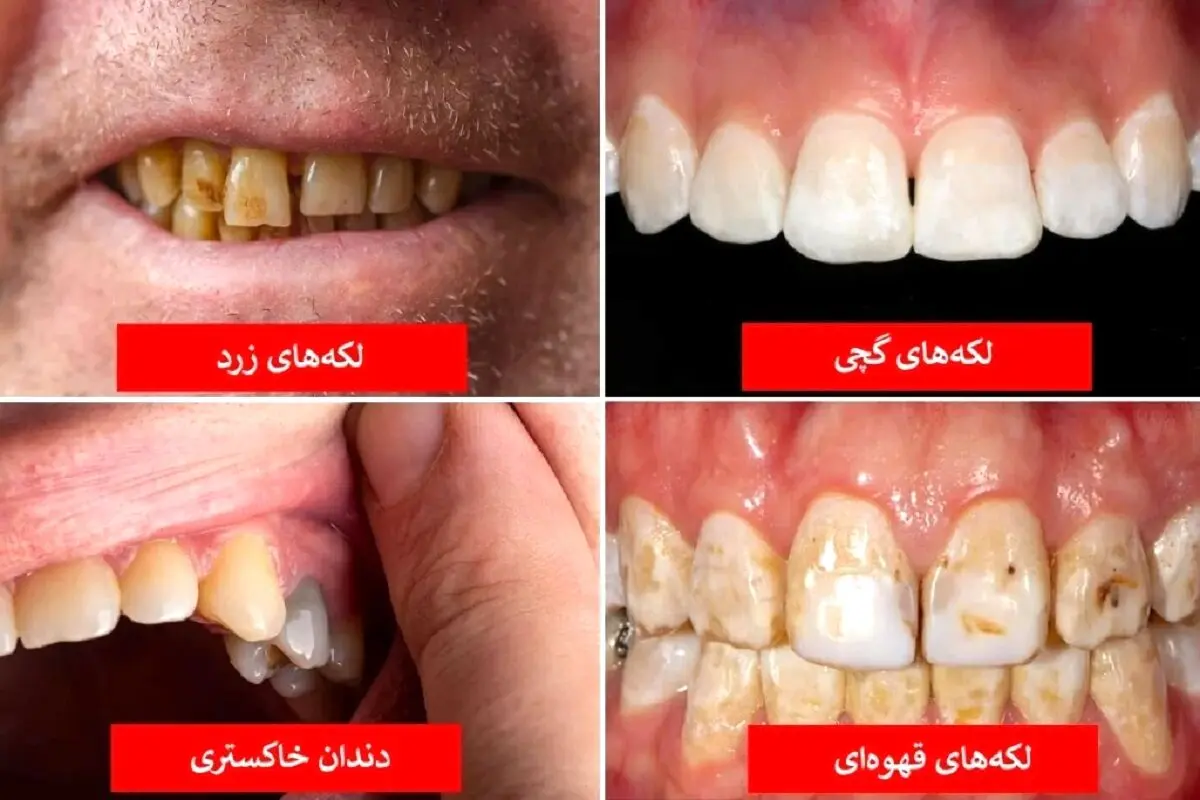 رنگ دندان‌ها را جدی بگیرید / این رنگ علائم مرگ است!
