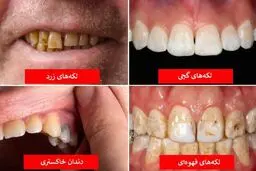 رنگ دندان‌ها را جدی بگیرید / این رنگ علائم مرگ است!
