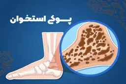 خوراکی‌های خطرناک  برای سلامت استخوان ها