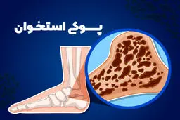 خوراکی‌های خطرناک  برای سلامت استخوان ها