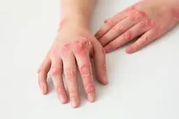 بیماری هزار چهره ی سیستم ایمنی را بشناسیم!