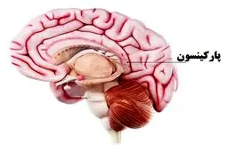چگونه علائم پارکینسون را  شناسایی کنیم؟