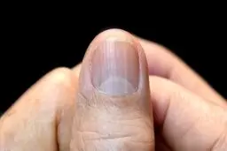اسراری که ناخن از سلامت ما برملا می‌کند