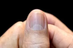 اسراری که ناخن از سلامت ما برملا می‌کند