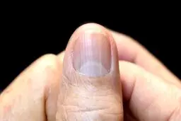 اسراری که ناخن از سلامت ما برملا می‌کند